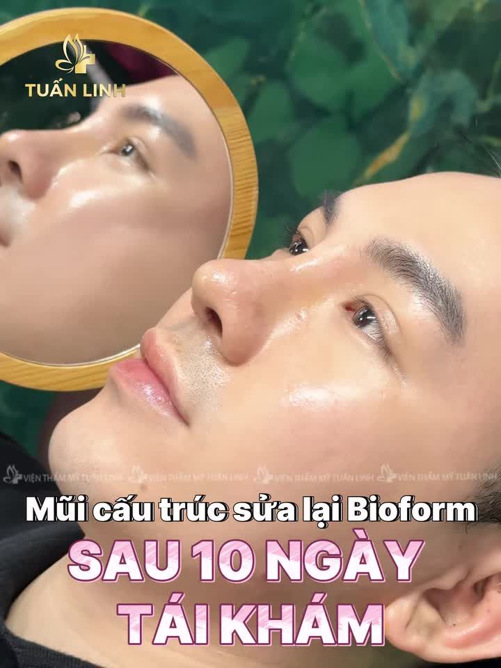 Mũi nam sửa lai đẹp ''cực phẩm'' sau 10 ngày tháo nẹp!!