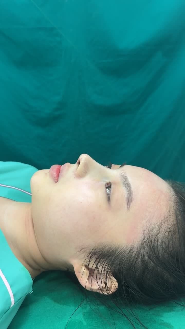 Case mũi cấu trúc bioform vừa hoàn thành!!