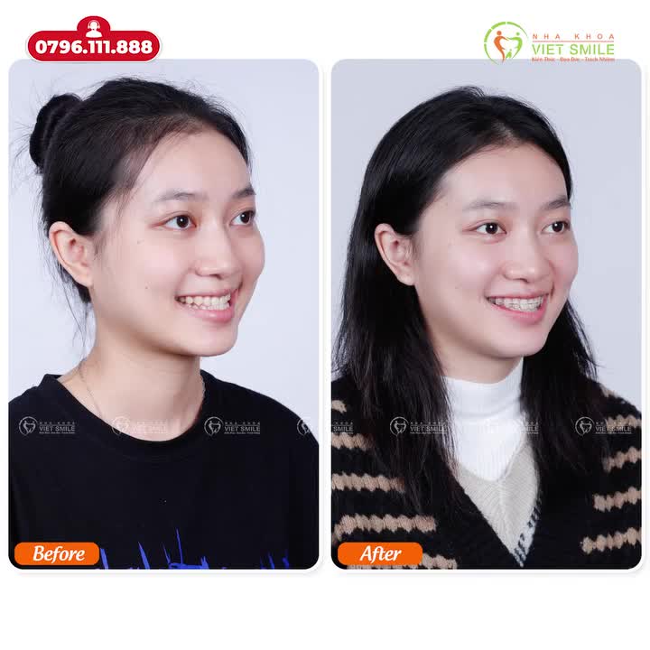 KOL Thảo Vân – Hành trình niềng răng khắc phục móm tại Viet Smile