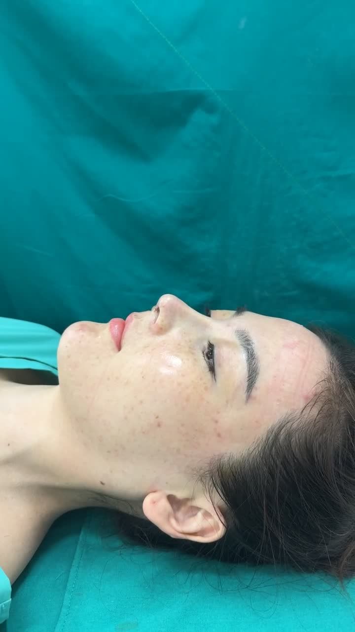 Dáng mũi Sline cao thanh tú cho khách hàng đến từ Đồng Nai!!