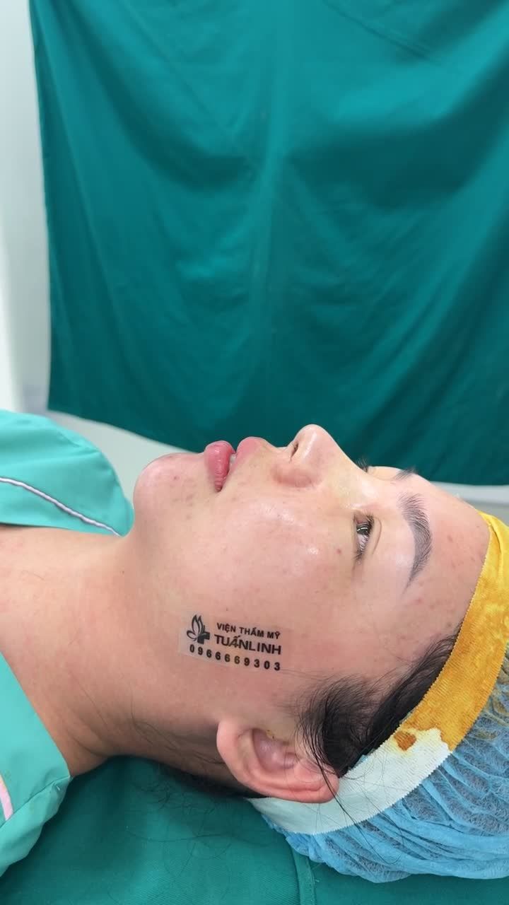 Combo nâng mũi bọc sụn + độn cằm vừa hoàn thành!!