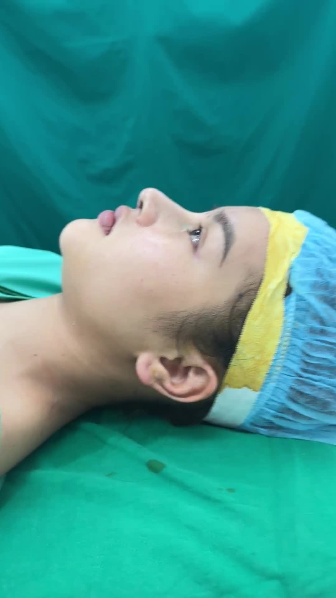 Form mũi xinh - khách hàng hài lòng ngay sau phẫu thuật!!