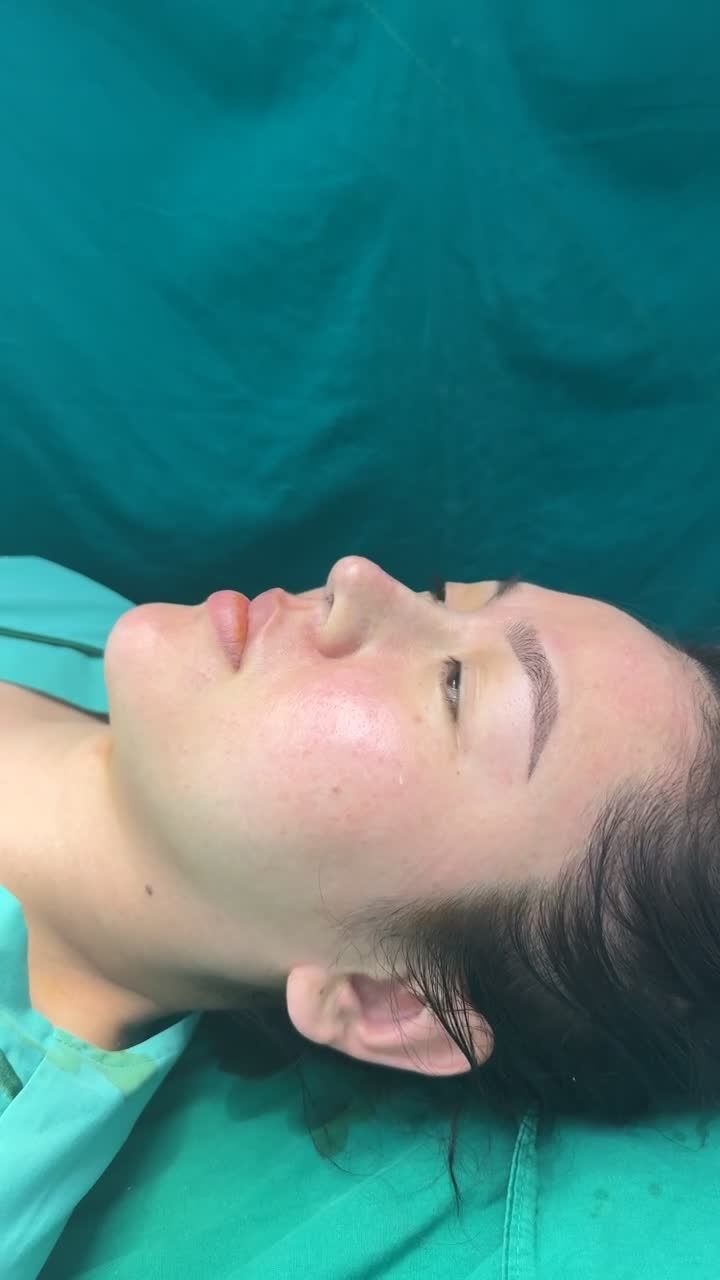 Case mũi cấu trúc vừa hoàn thành - Dáng mũi cao thanh tú, đẹp sắc nét!!