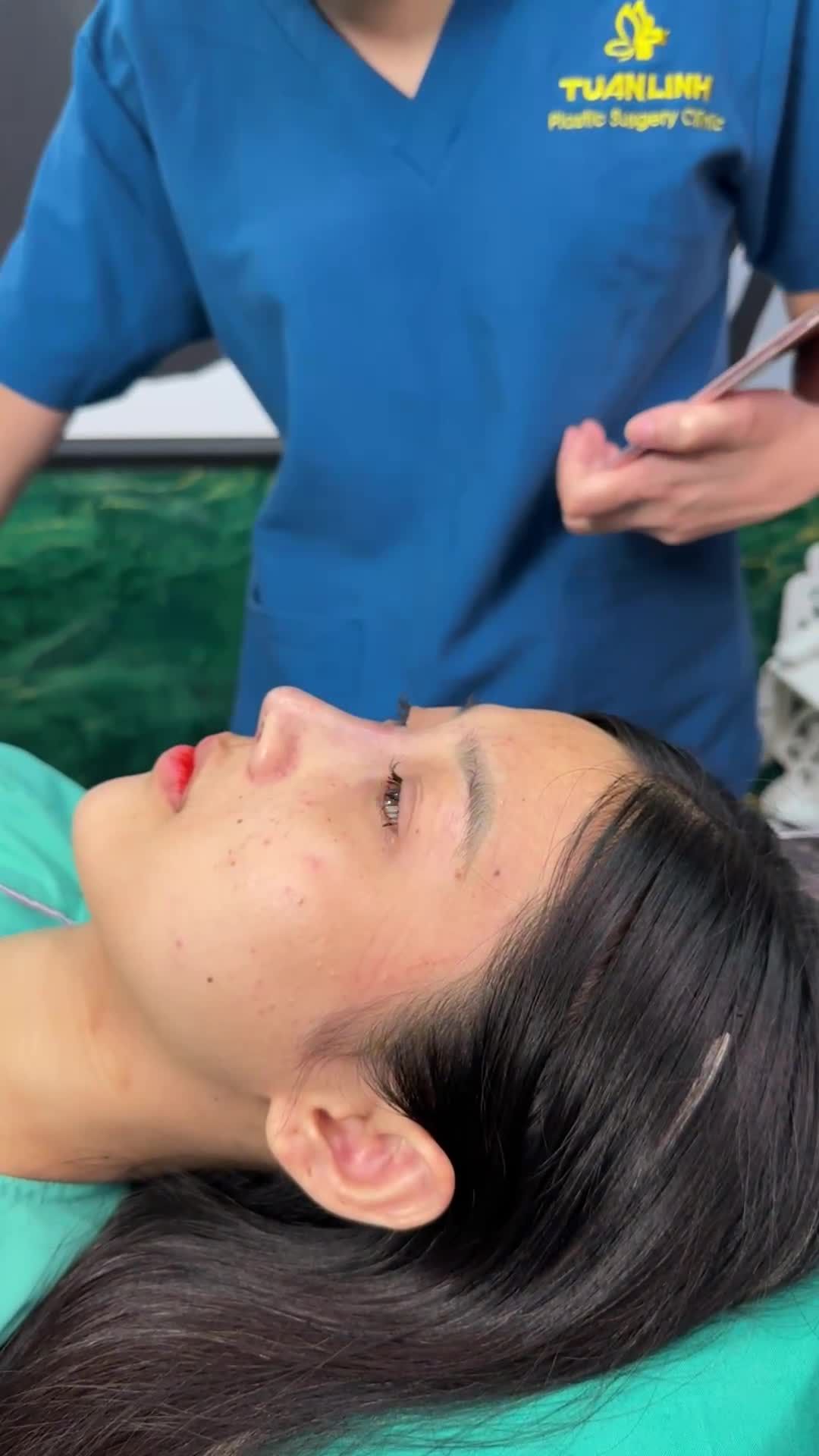 Ca nâng mũi cấu trúc sụn Bioform - Dáng tự nhiên - Đẹp xuất sắc ngay sau thực hiện!!