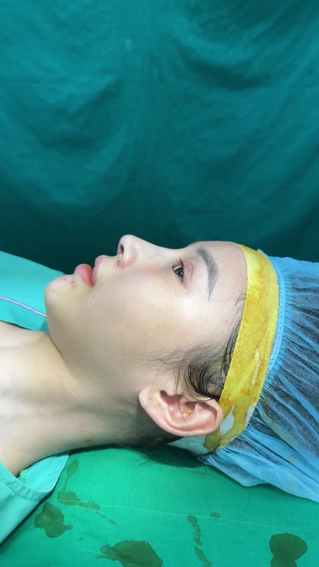 Mũi cấu trúc sụn surgiform vừa xong cho bạn gái đến từ Vũng Tàu!!
