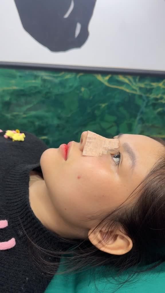 Case mũi cấu trúc sau 10 ngày