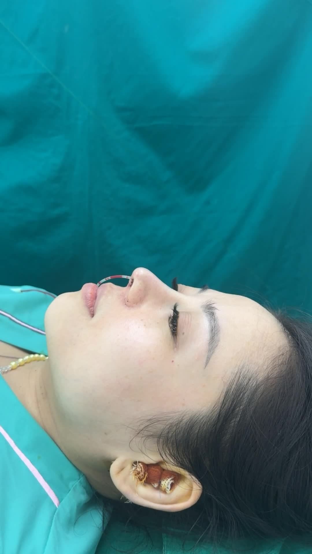 Case mũi cấu trúc sửa lại vừa hoàn thành!!