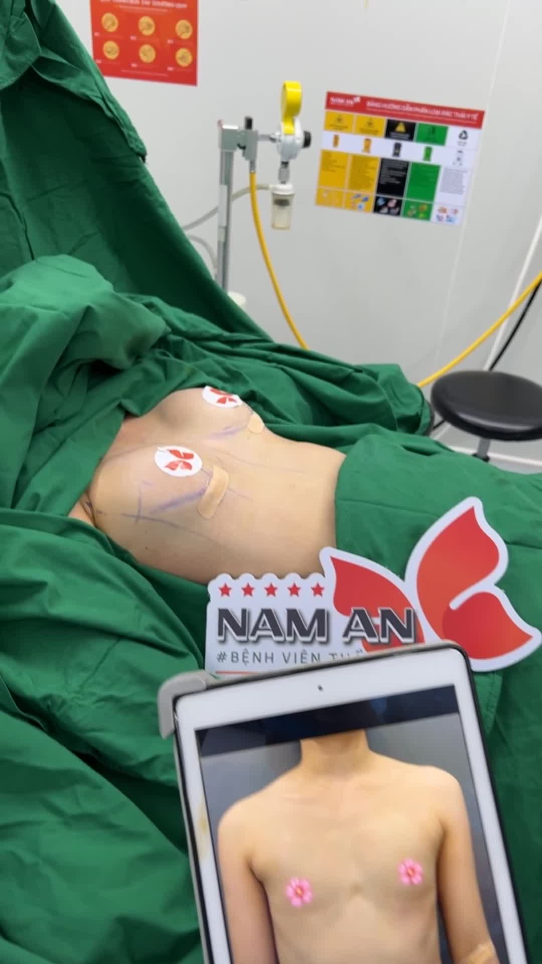 HOÀN THÀNH CA NÂNG NGỰC LỆCH SIZE   Mentor 325cc- 350cc