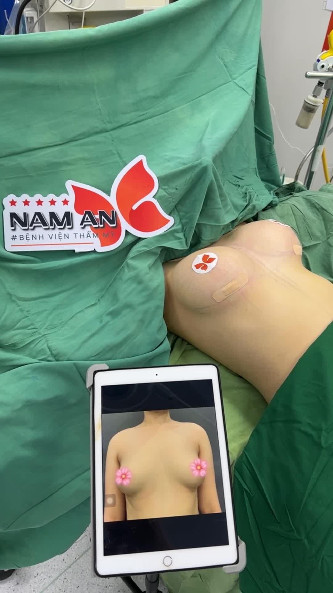 Khắc phục khe ngực xa bằng phương pháp nâng ngực đặt túi