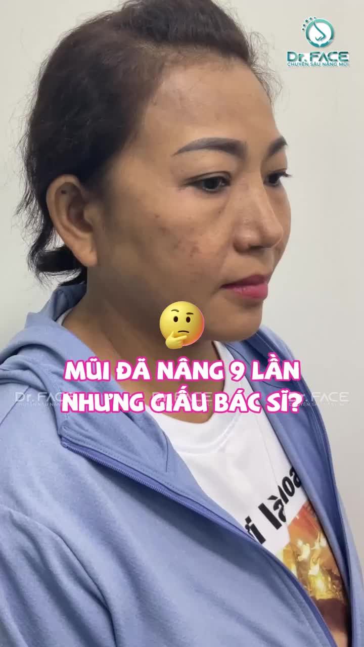 Nâng mũi 9 LẦN mà “GIẤU BỚT” còn có 6 LẦN