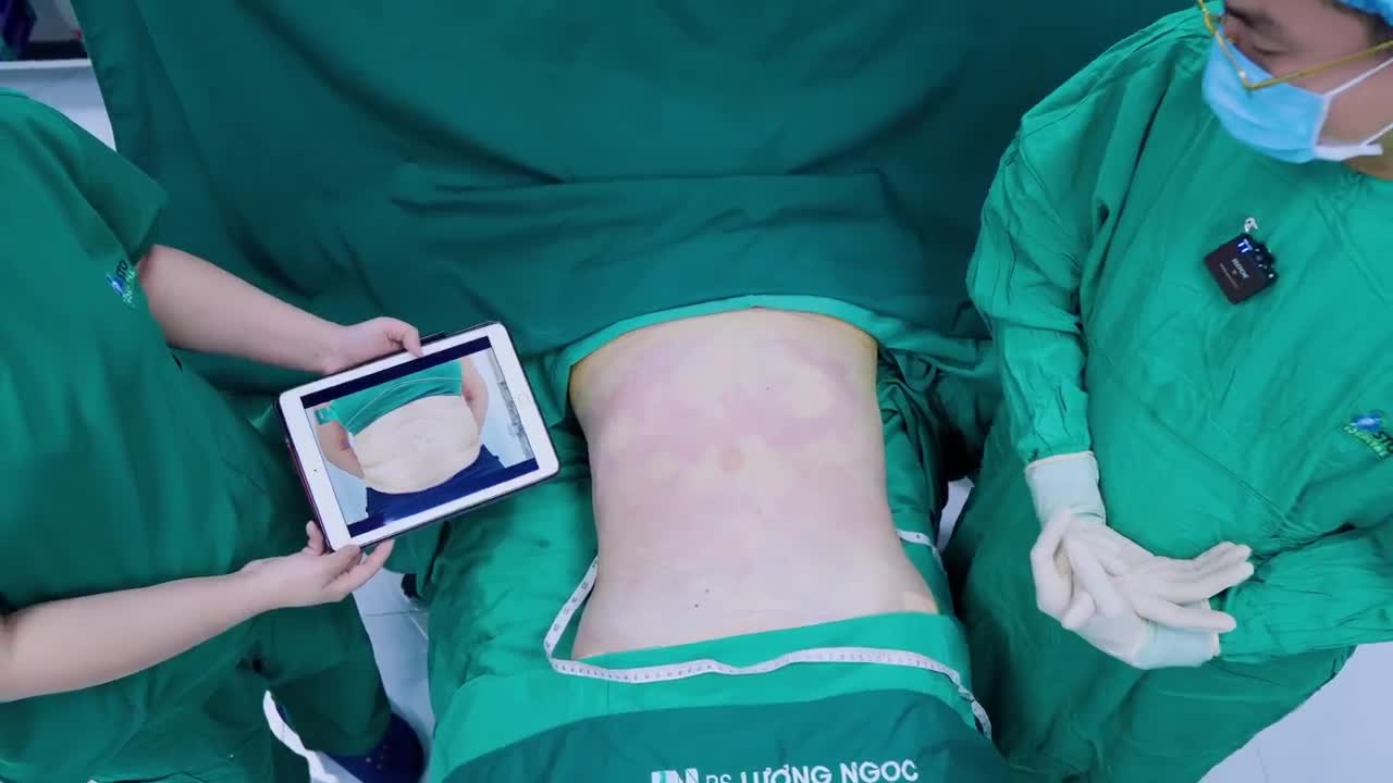 Mang trên mình vòng eo ngấn mỡ, da bụng có chỗ lồi, chỗ lõm - Chị H phải sống với nỗi tự ti và mặc cảm sau khi từng hút mỡ thất bại.