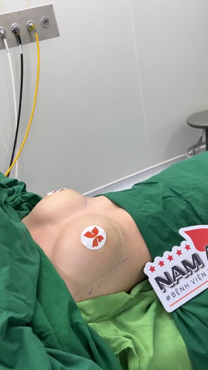 HOÀN THÀNH CA NÂNG NGỰC  MENTOR EXTRA 295cc