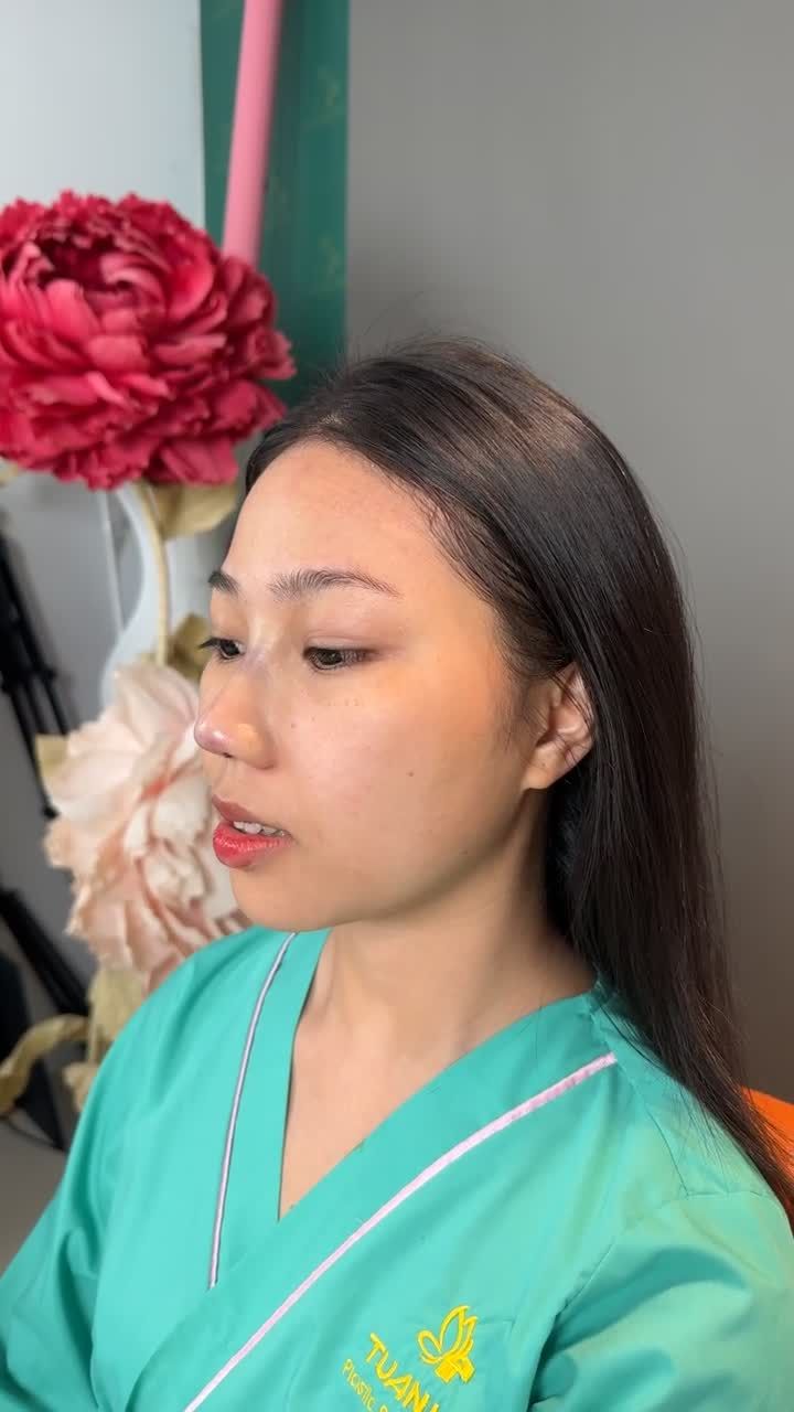 Case mũi cấu trúc vừa hoàn thành!!