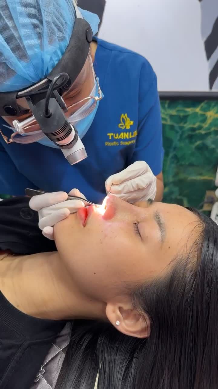 Case mũi cấu trúc sau 10 ngày!!