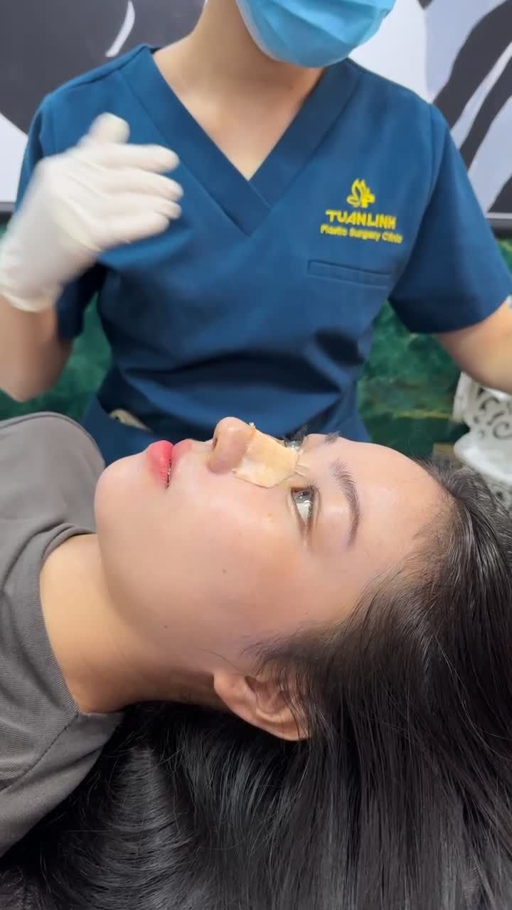 Case mũi cấu trúc được 10 ngày đẹp xuất sắc!!