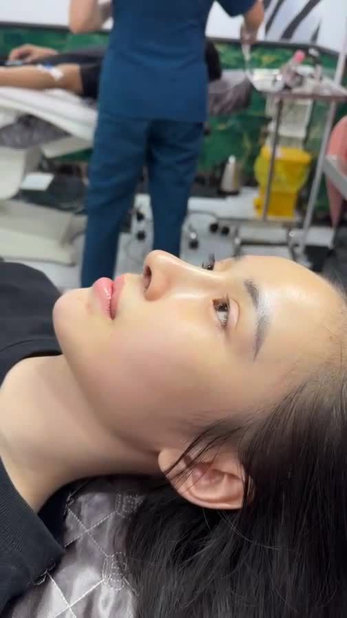 Case mũi cấu trúc sau 10 ngày!!