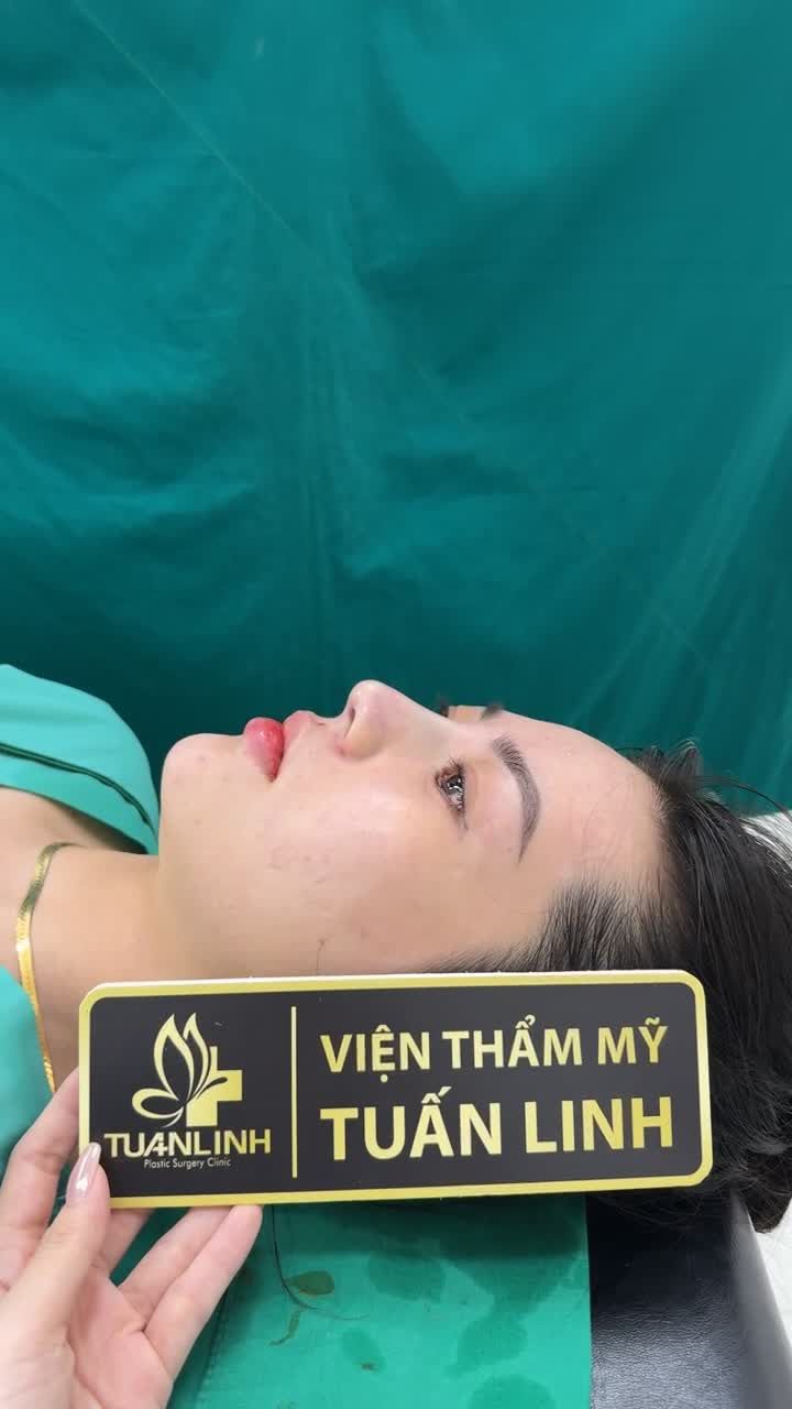Mũi bọc sụn ít xâm lấn, nhanh hồi phục, đẹp tự nhiên, giá ''hạt dẻ'' sở hữu dáng mũi đẹp chất lượng.