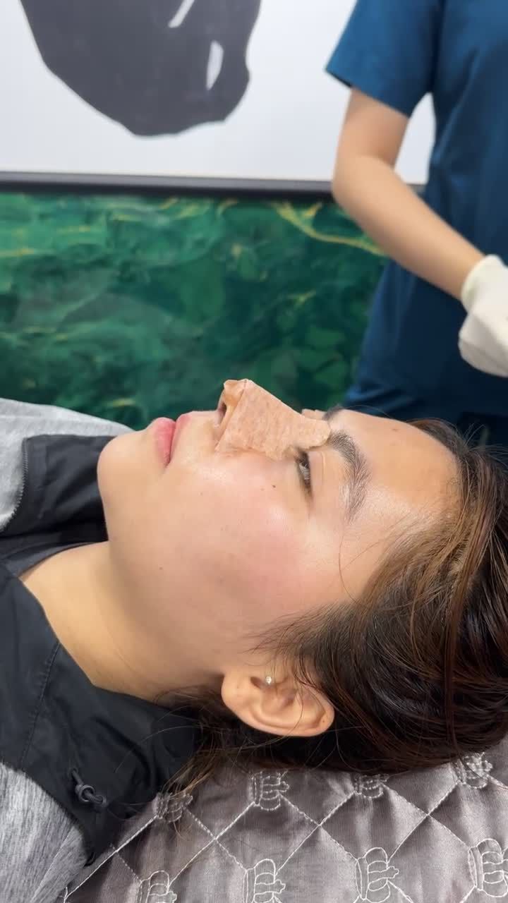 Case mũi cấu trúc sau 5 ngày đã vào form đẹp tự nhiên!!