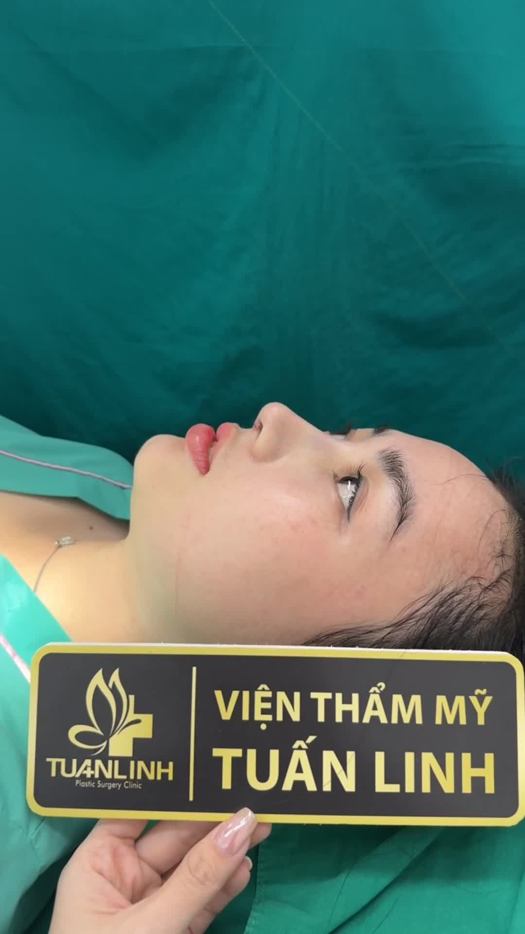 Case mũi cấu trúc vừa hoàn thành - Dáng mũi đẹp tự nhiên nhưng vẫn rất sắc nét và tôn dáng cho gương mặt!