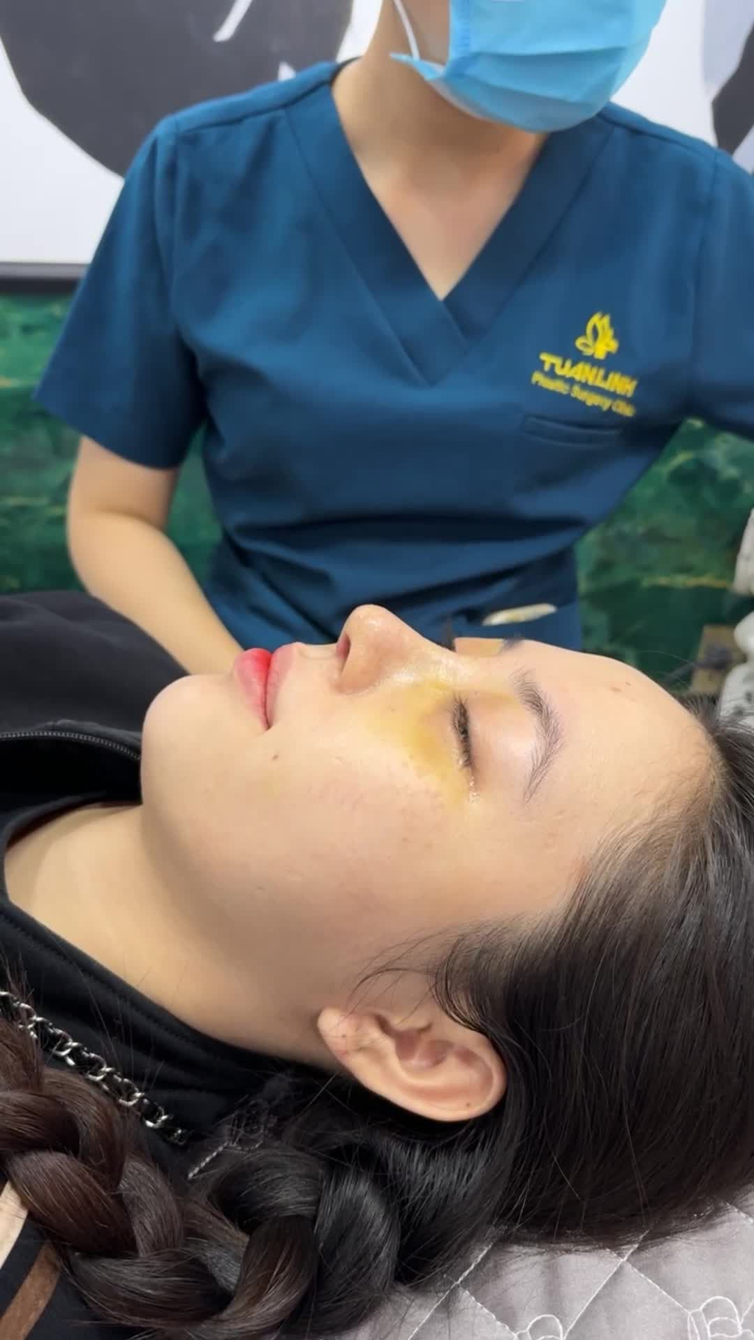 Case mũi cấu trúc sau 10 ngày