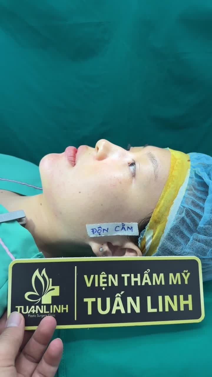 Độn cằm 15 củ thay đổi cả khuôn mặt !!