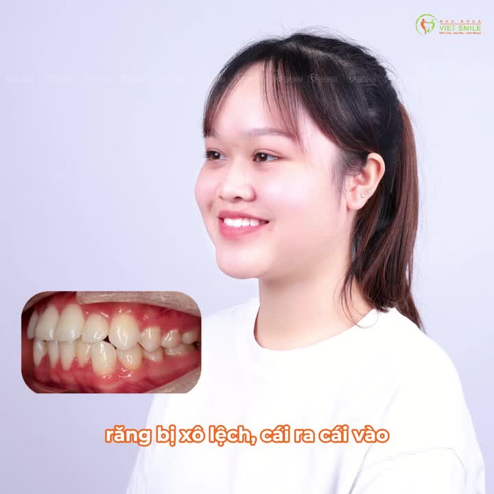 "Niềng răng là quyết định đúng đắn nhất cuộc đời em..."