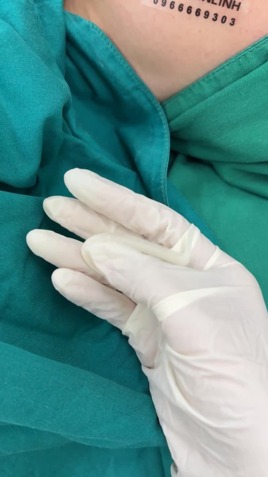Case mũi cấu trúc sửa lại sụn bioform vừa hoàn thành!!