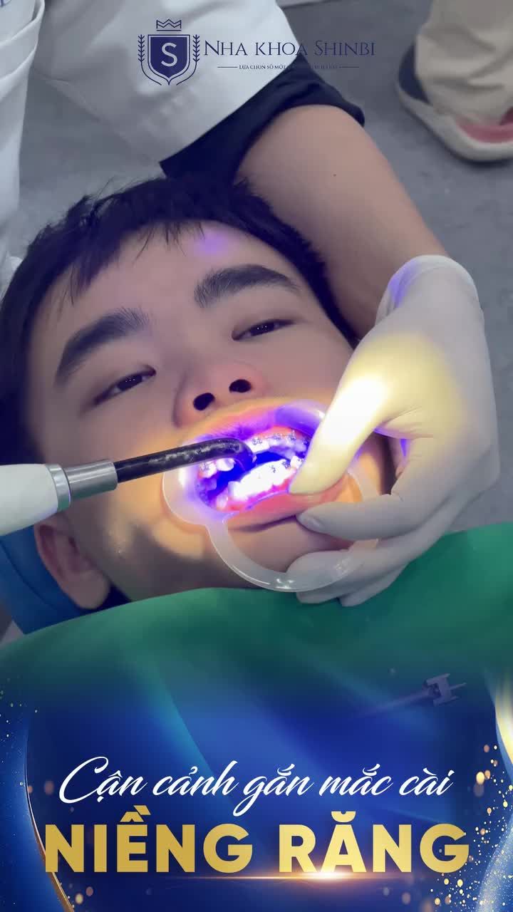 CẬN CẢNH GẮN MẮC CÀI NIỀNG RĂNG CUỐI TUẦN TẠI SHINBI