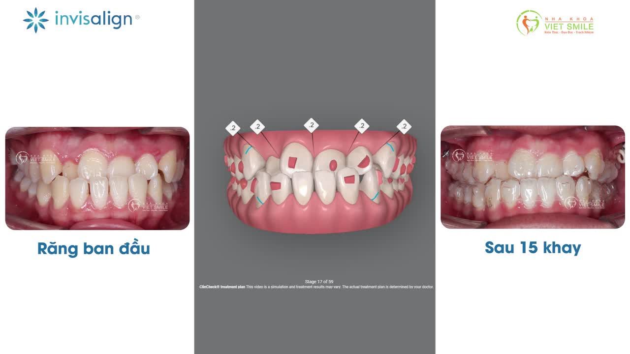 Bạn có bao giờ tự hỏi: Răng mình sẽ dịch chuyển thế nào khi niềng? Có đúng theo kế hoạch ban đầu không?