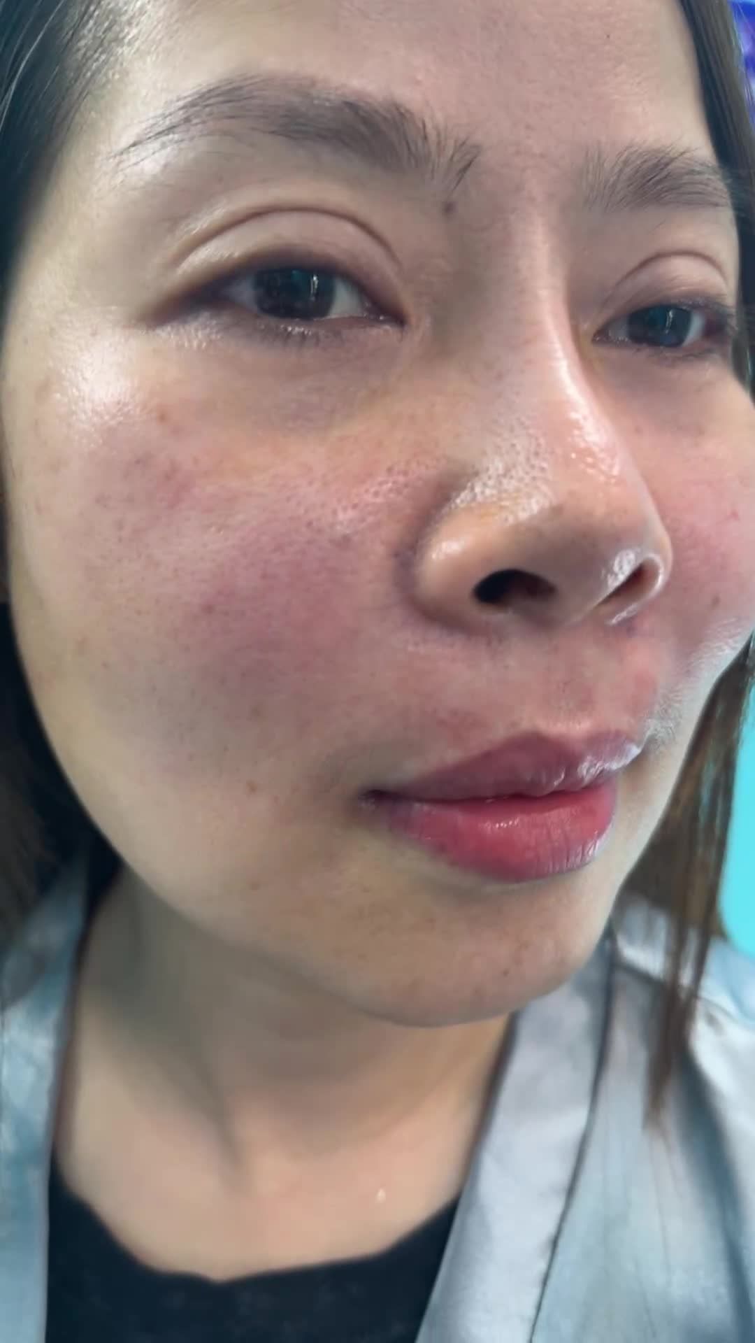 Độn rãnh mũi má xoá đường hằn sâu !