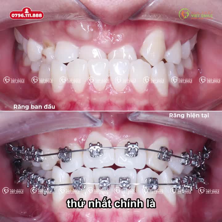 CHỈ 5 THÁNG –  "XÓA SỔ" RĂNG MÓM! BẠN CÓ TIN KHÔNG?
