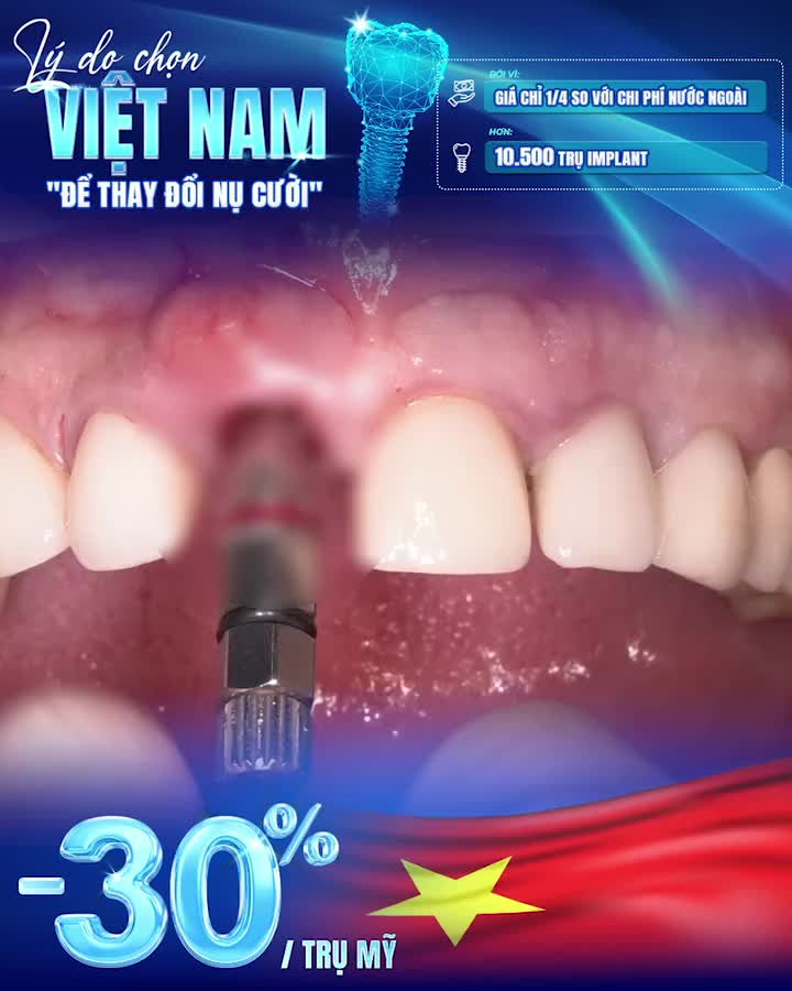 -30% IMPLANT MỸ CAO CẤP, TIẾT KIỆM 7 TRIỆU ĐỒNG
