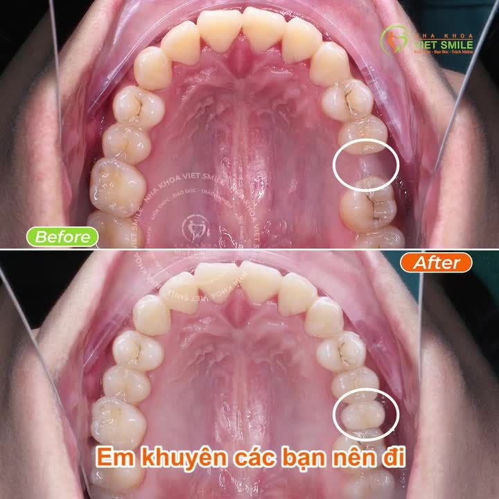 ƯU ĐÃI NIỀNG RĂNG ĐỘC QUYỀN TẠI NHÂN TÂM