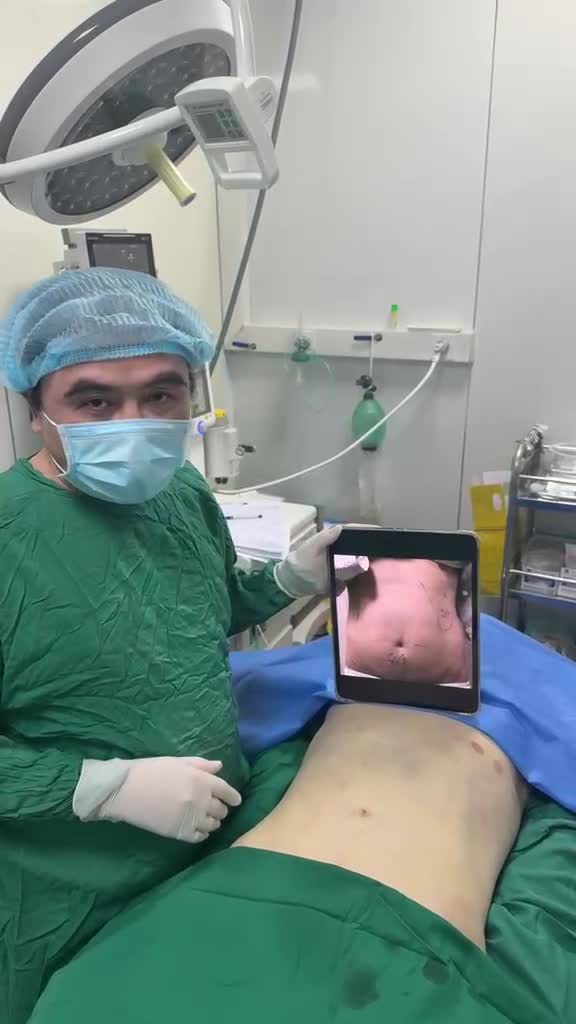 Ca ngày 3/4/2025: Hút kiệt mỡ bụng eo với Bác sĩ Vương