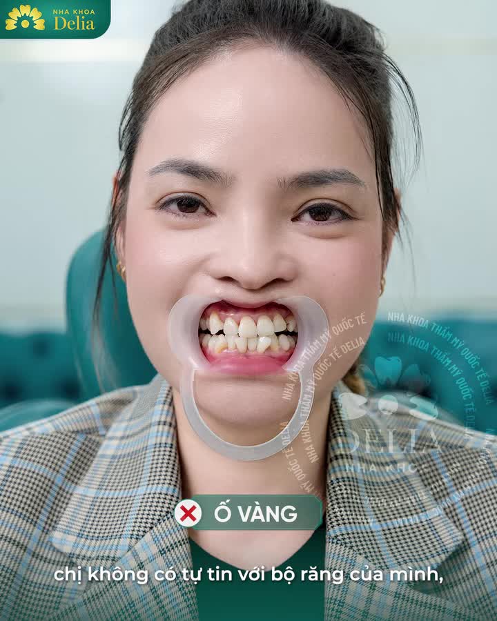 "Làm răng sứ tại Delia tôi rất an tâm tay nghề bác sĩ" - Một lời chia sẻ chân thành từ chị Phương Dung (ở Long Biên) sau khi làm trọn bộ 18 răng sứ Emax cao cấp của Đức