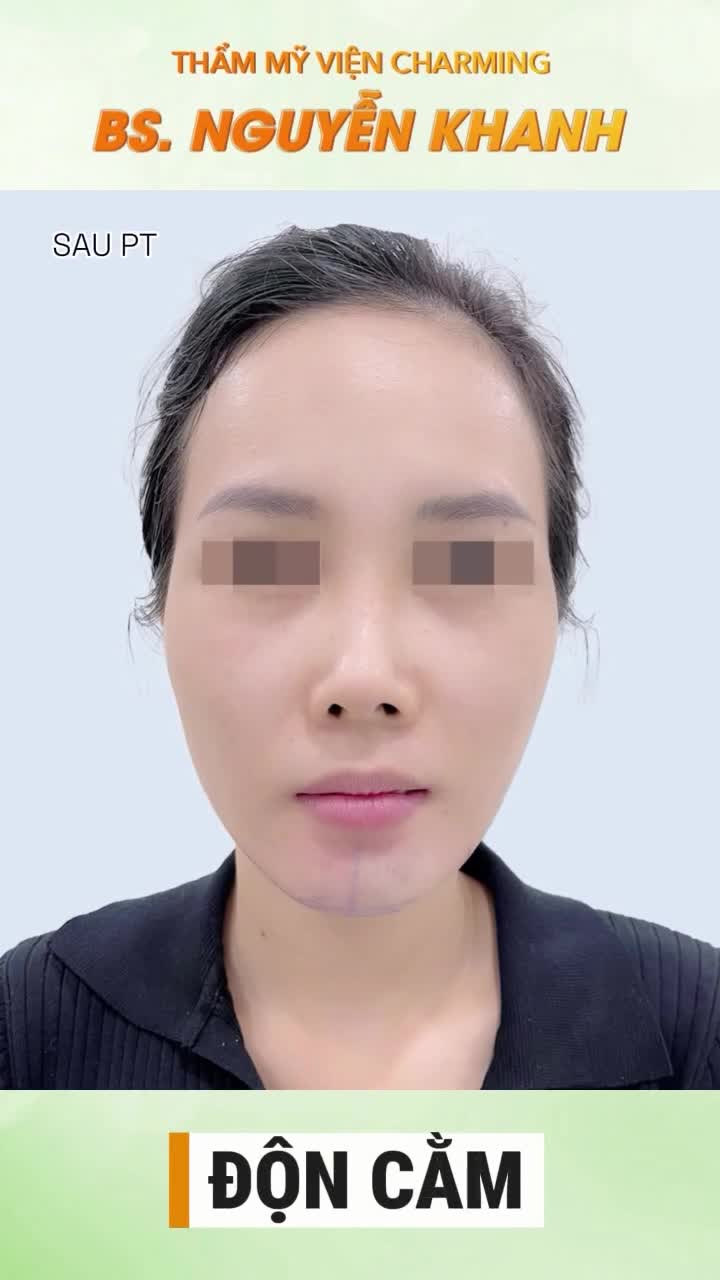 Trước khi đến với Charming, nàng có khuôn cằm hơi ngắn, khiến tổng thể gương mặt chưa thực sự hài hoà, góc nghiêng cũng thiếu điểm nhấn. Dù đường nét vẫn nhẹ nhàng nhưng chưa đủ độ thanh thoát.