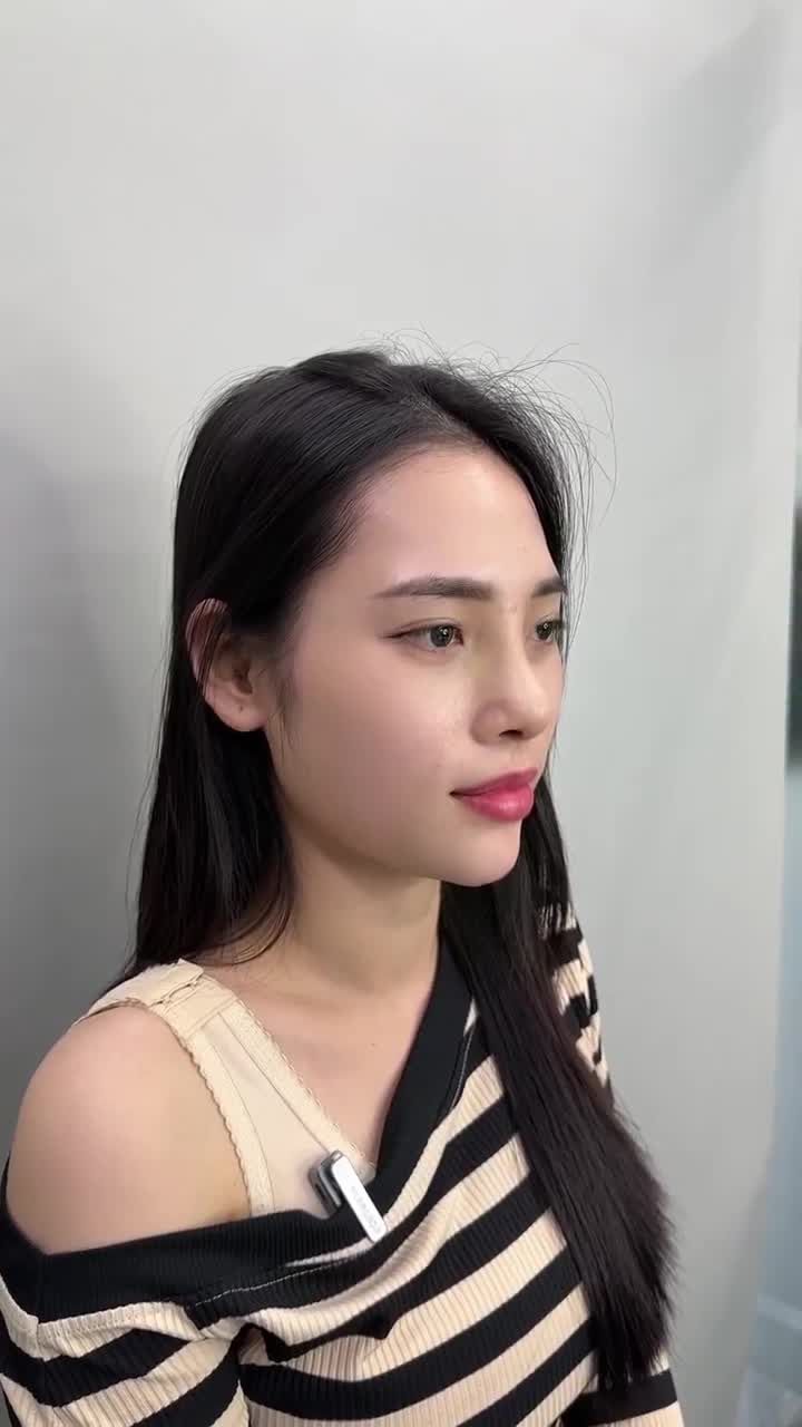 "LỘT XÁC" DIỆN MẠO, XINH ĐẸP NHƯ Ý SAU 10 NGÀY NÂNG MŨI CẤU TRÚC