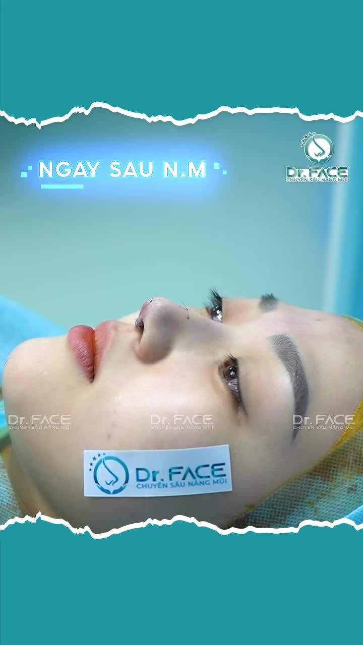 QUY TRÌNH nâng mũi CẤU TRÚC cho CÔ GIÁO CẤP 1