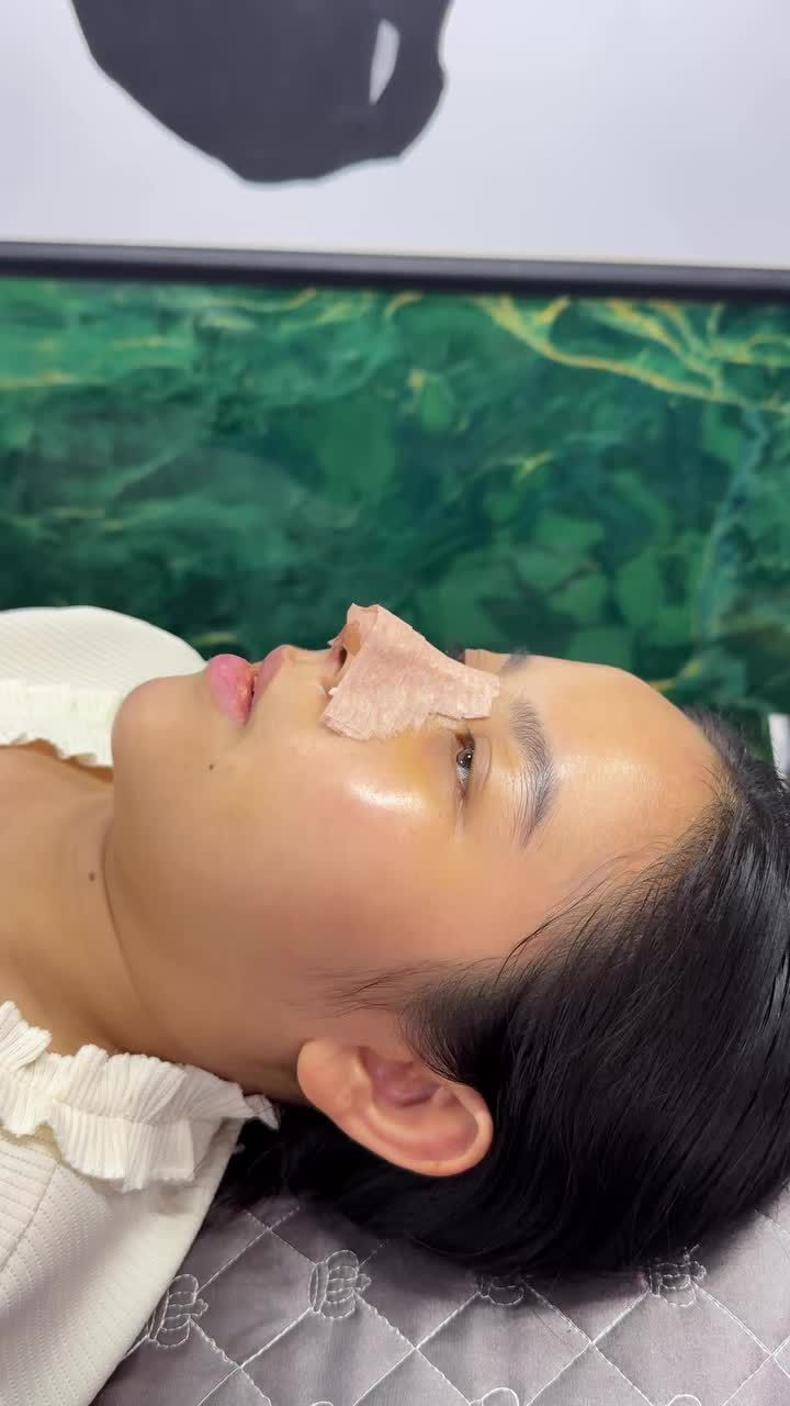 Case mũi cấu trúc surgiform được 5 ngày!!