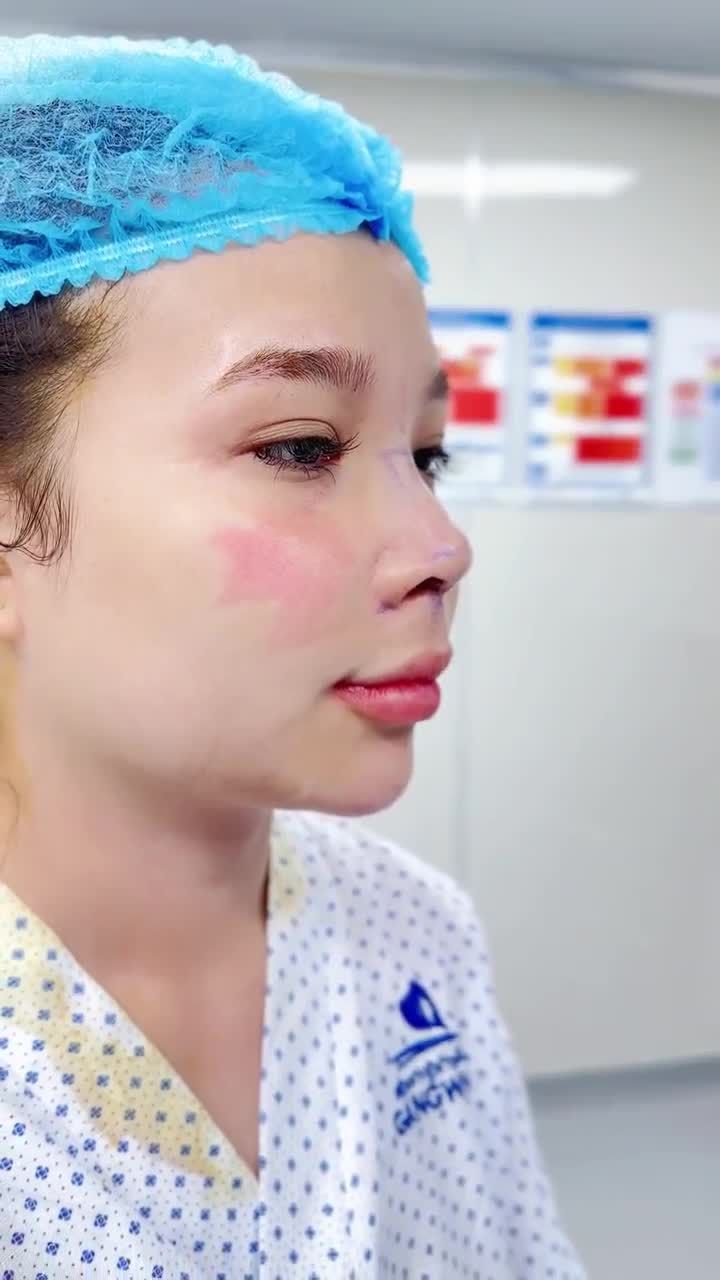 CÔ BẠN GEN Z  SAU 1 NĂM ĐẮN ĐO, CUỐI CÙNG CŨNG THỰC HIỆN NÂNG MŨI CẤU TRÚC TẠI BVTM GANGWHOO