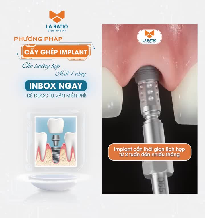 Khách hàng gặp tình trạng mất 1 răng và đây là cách khắc phục. Đẹp là khi bạn nhìn lại mình và mỉm cười thật tươi với hàm răng chắc khoẻ. Đăng ký ngay hôm nay!