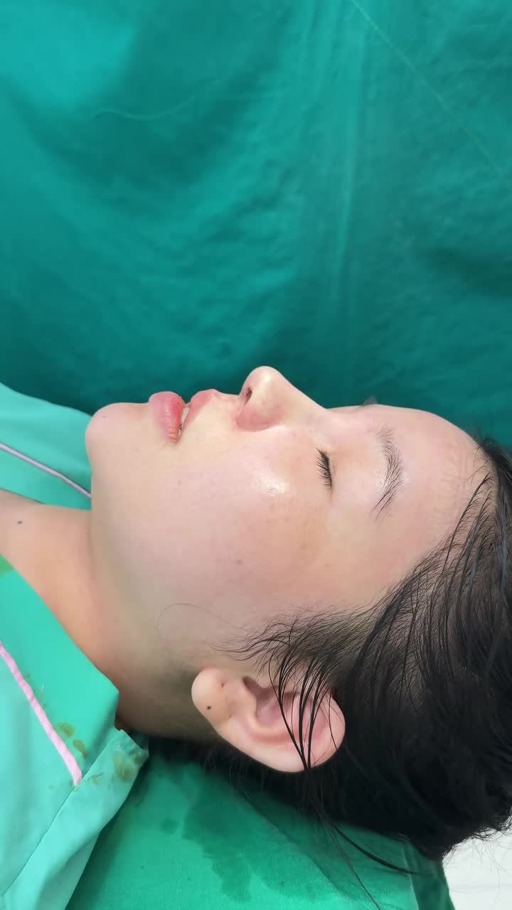 Case mũi cấu trúc surgiform vừa hoàn thành!!