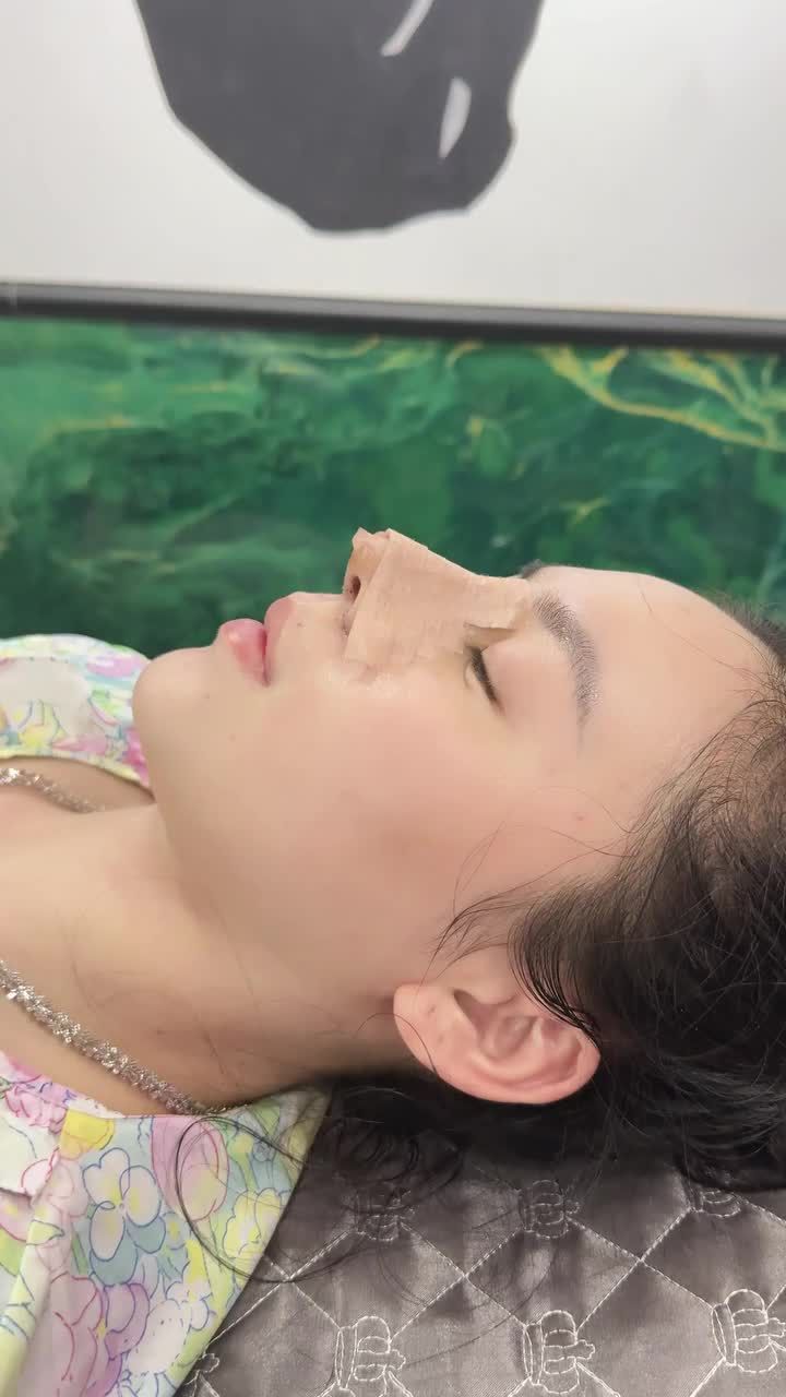 Cận cảnh form mũi sau 5 ngày thay nẹp!!!