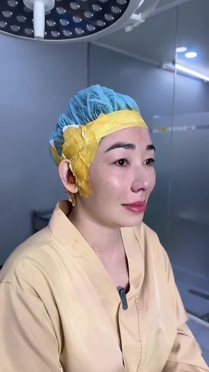 KẾT QUẢ SAU NÂNG MŨI CẤU TRÚC KH. CHỊ HOA