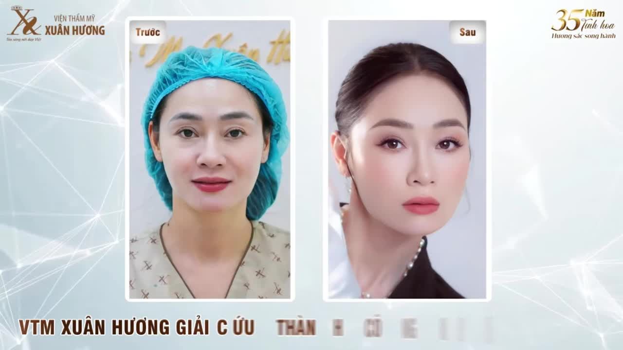 CẮT MÍ LỖI HỎNG – NỖI ÁM ẢNH CỦA NHIỀU KHÁCH HÀNG, NHƯNG KHÔNG PHẢI LÀ “ÁN TỬ” CHO NHAN SẮC!