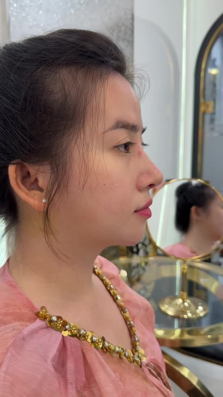 Case mũi cấu trúc bioform được 10 ngày