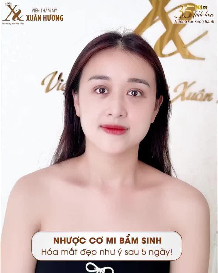 Nhược cơ mi bẩm sinh – Đừng để đôi mắt kém sắc cản trở ánh nhìn của bạn!