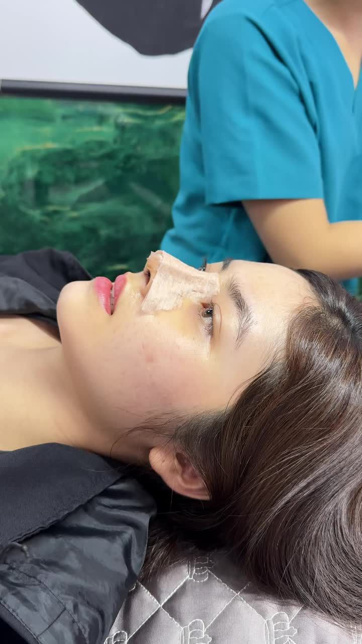 Case mũi cấu trúc bioform được 5 ngày