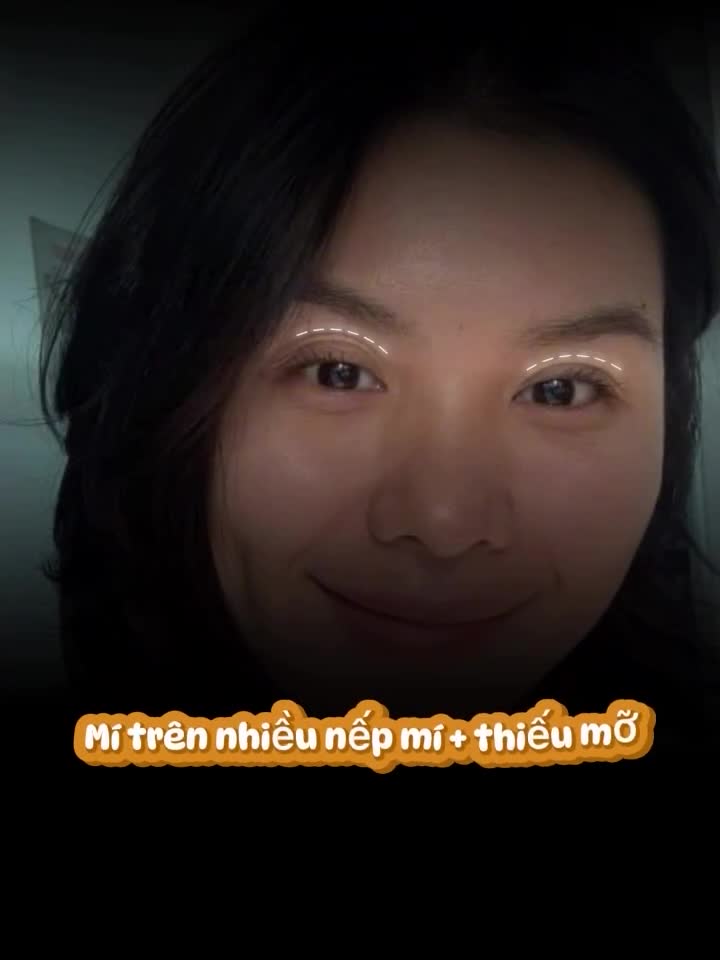 Trước khi làm đẹp, vùng mí trên của nàng hơi trũng nhẹ, làm ánh nhìn trông mệt mỏi và thiếu sức sống. Nhưng chỉ sau một lần cấy mỡ, nàng đã thật sự khác biệt.