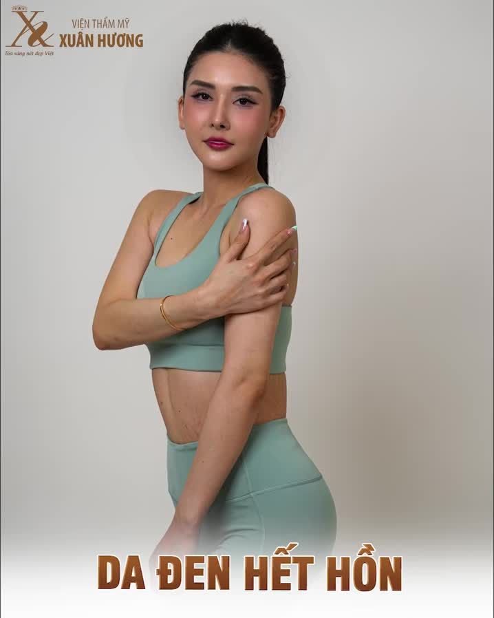 MÙA HÈ ĐẾN, LÀN DA "KÊU CỨU" VÌ: Bắt nắng nhanh, vừa đi biển về đã sạm? Da không đều màu, loang lổ, kém tự tin?Thâm xỉn, xám xịt, makeup cũng không "cứu" nổi? Đừng để nắng hè làm bạn tụt mood!